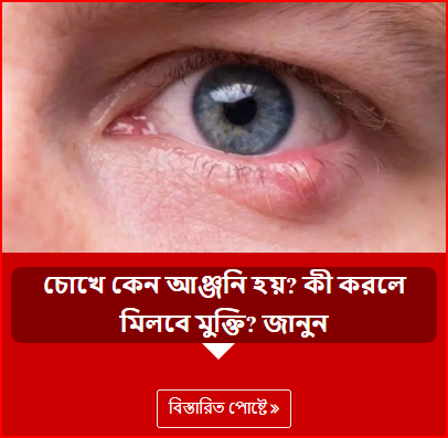 চোখে কেন আঞ্জনি হয়? কী করলে মিলবে মুক্তি? জানুন